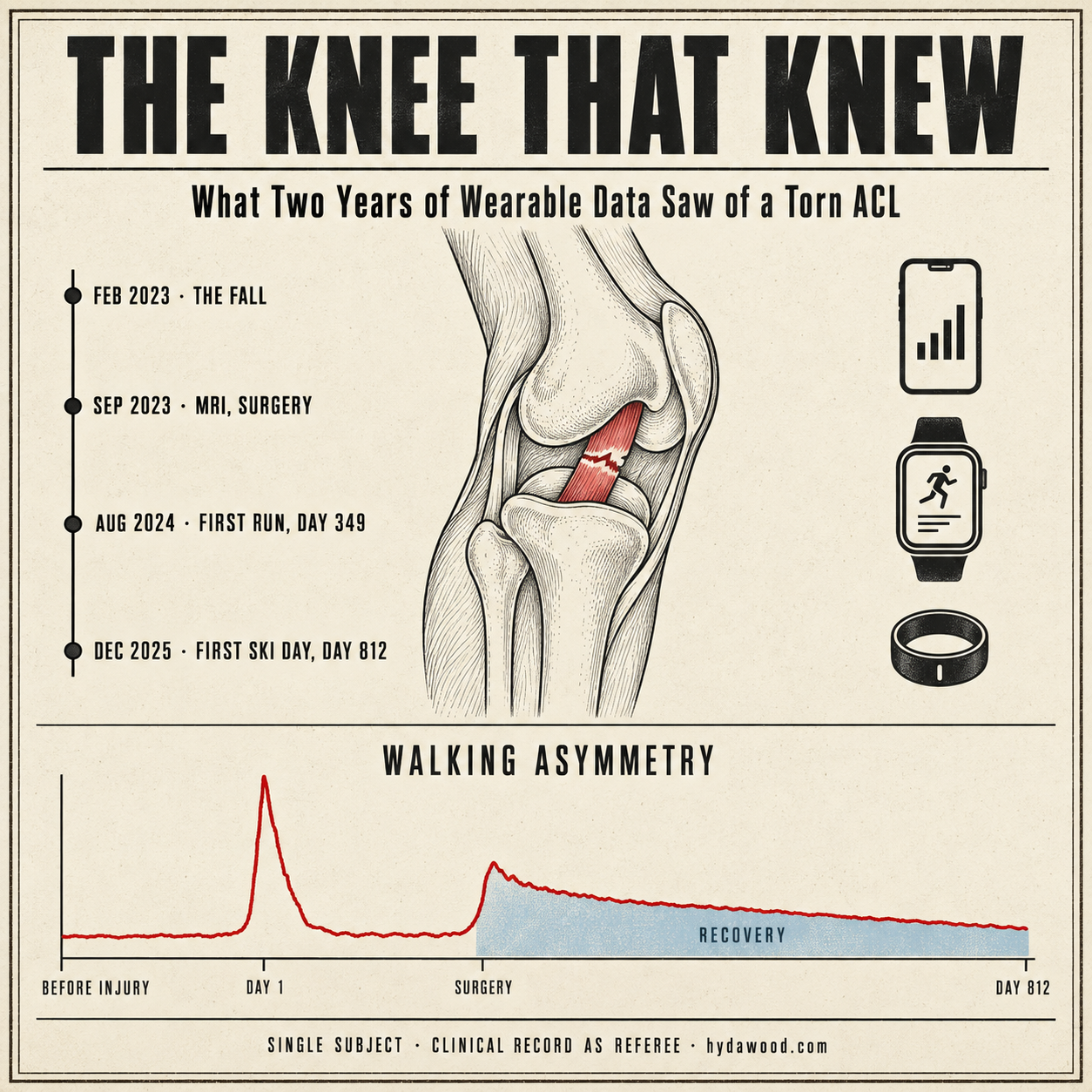 The Knee That Knew: A Torn ACL in Wearable Data